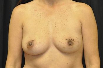 Breast Reconstruction Before & After Photo Patient 29 Thumbnail
