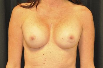 Breast Reconstruction Before & After Photo Patient 31 Thumbnail