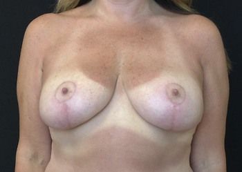 Breast Reduction Before & After Patient 06