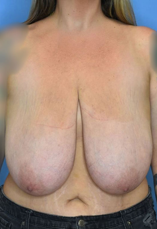 Breast Reduction Before & After Photo Patient 15 Thumbnail