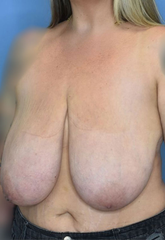 Breast Reduction Before & After Photo Patient 15 Thumbnail