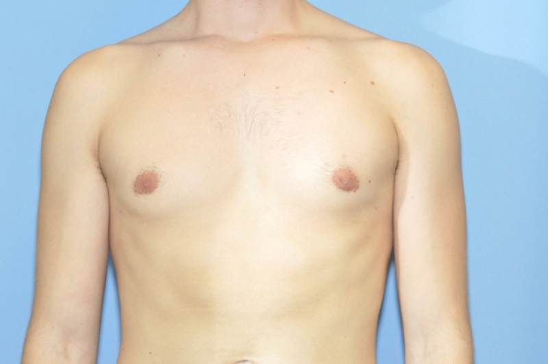 Male Breast Reduction Before & After Photo Patient 01 Thumbnail