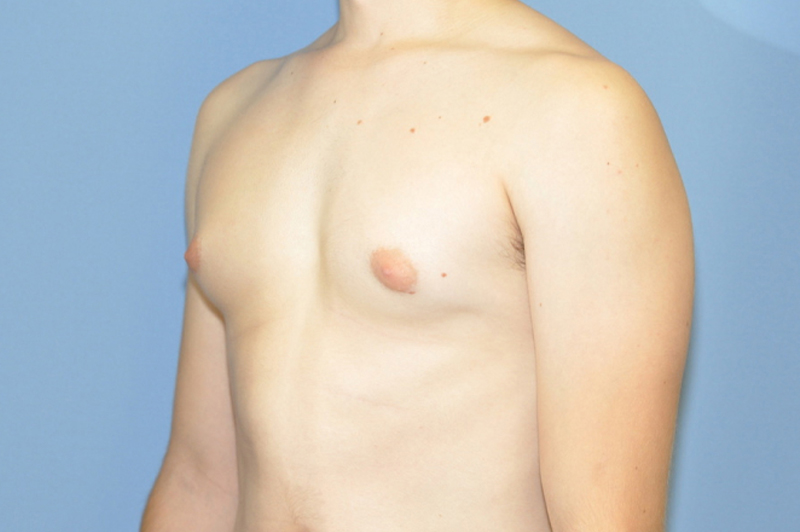 Male Breast Reduction Before & After Photo Patient 01 Thumbnail