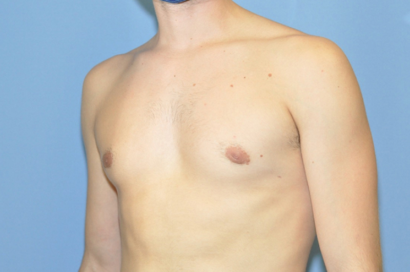 Male Breast Reduction Before & After Photo Patient 01 Thumbnail