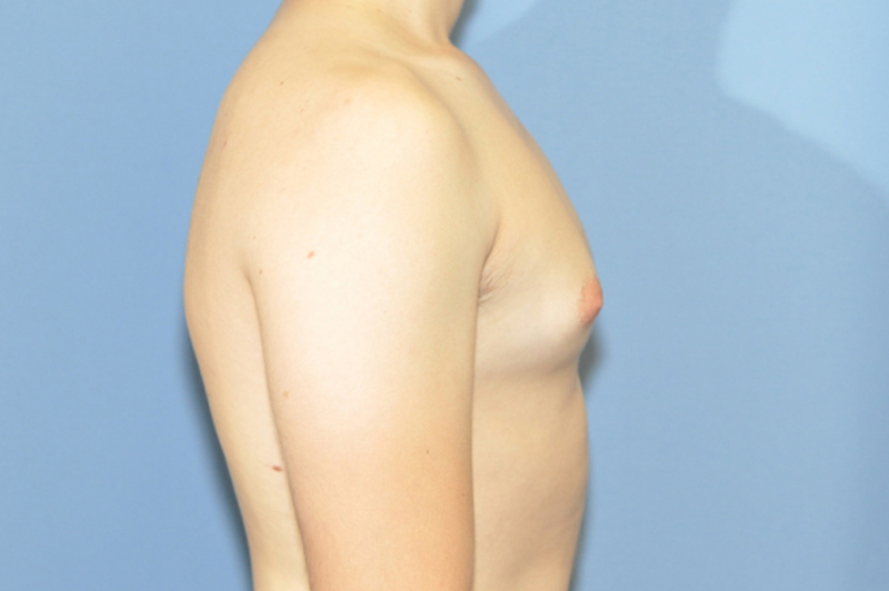 Male Breast Reduction Before & After Photo