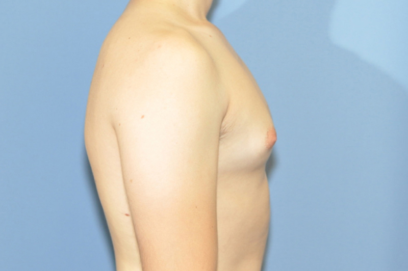 Male Breast Reduction Before & After Patient 01