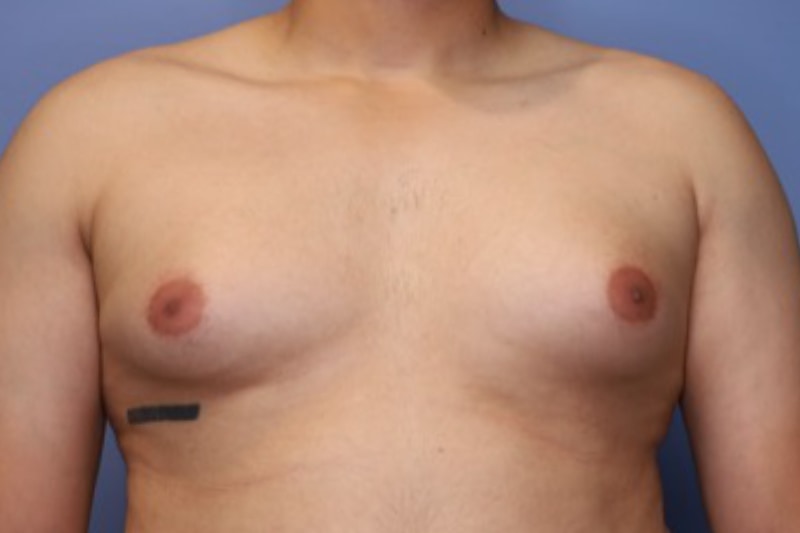 Male Breast Reduction Before & After Patient 02