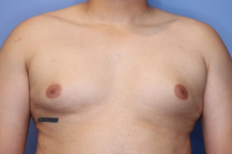 Male Breast Reduction Before & After Patient 02