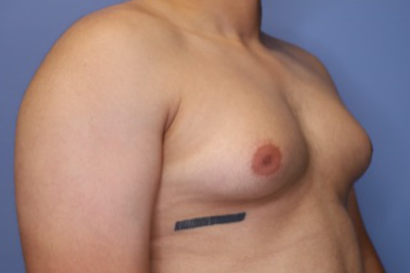 Male Breast Reduction Before & After Patient 02