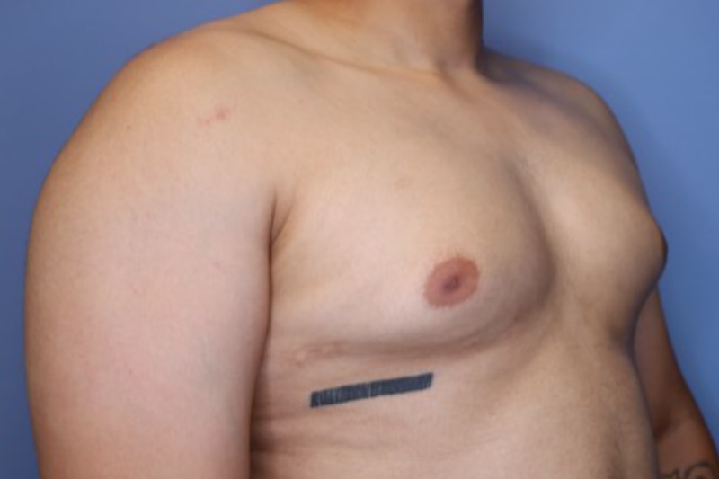 Male Breast Reduction Before & After Patient 02