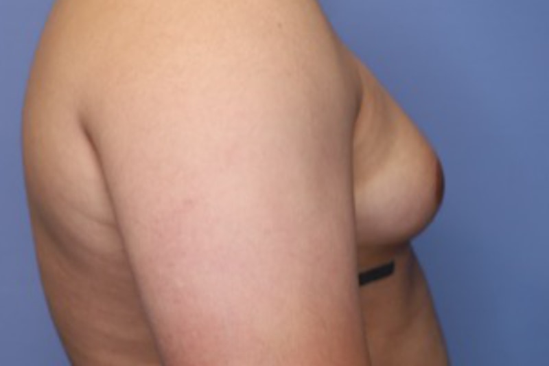 Male Breast Reduction Before & After Patient 02