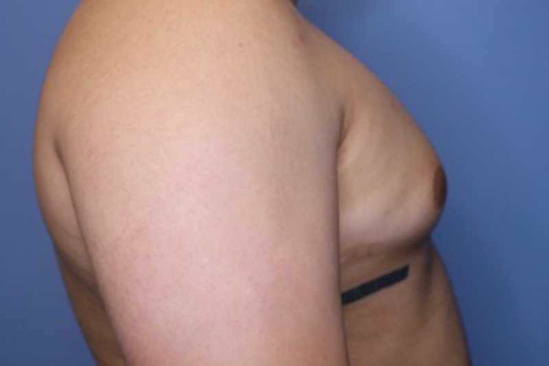 Male Breast Reduction Before & After Patient 02