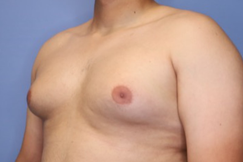 Male Breast Reduction Before & After Patient 02