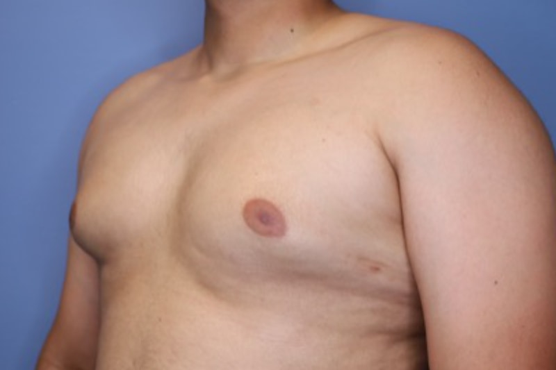 Male Breast Reduction Before & After Patient 02