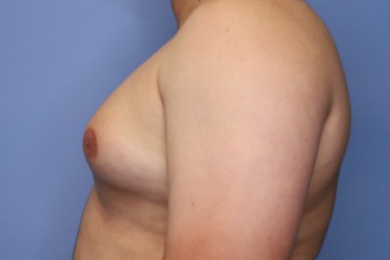 Male Breast Reduction Before & After Patient 02