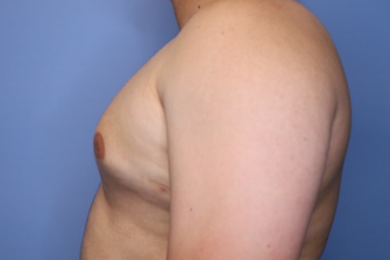 Male Breast Reduction Before & After Patient 02