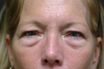 Eyelid Blepharoplasty Before & After Photo Patient 01 Thumbnail
