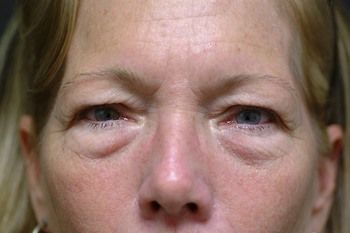 Eyelid Blepharoplasty Before & After Patient 01