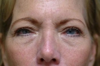 Eyelid Blepharoplasty Before & After Photo Patient 01 Thumbnail