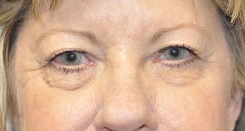 Eyelid Blepharoplasty Before & After Photo Patient 02 Thumbnail