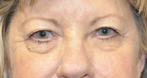 Eyelid Blepharoplasty Before & After Photo Patient 02 Thumbnail