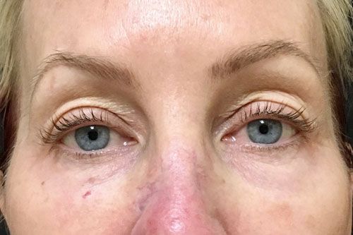 Eyelid Blepharoplasty Before & After Photo Patient 03 Thumbnail