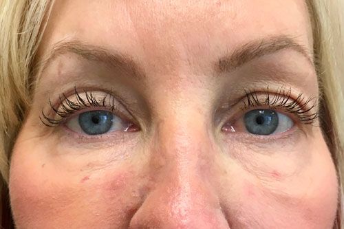 Eyelid Blepharoplasty Before & After Patient 03