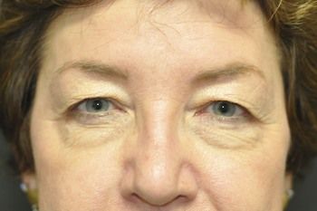 Eyelid Blepharoplasty Before & After Patient 05