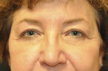 Eyelid Blepharoplasty Before & After Photo Patient 05 Thumbnail