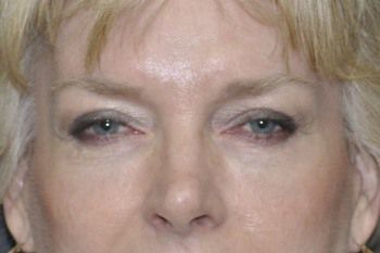 Eyelid Blepharoplasty Before & After Patient 06