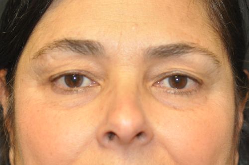 Eyelid Blepharoplasty Before & After Patient 07