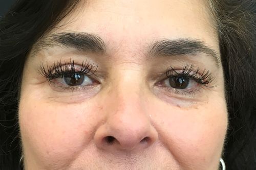 Eyelid Blepharoplasty Before & After Photo Patient 07 Thumbnail