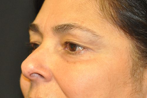 Eyelid Blepharoplasty Before & After Patient 07