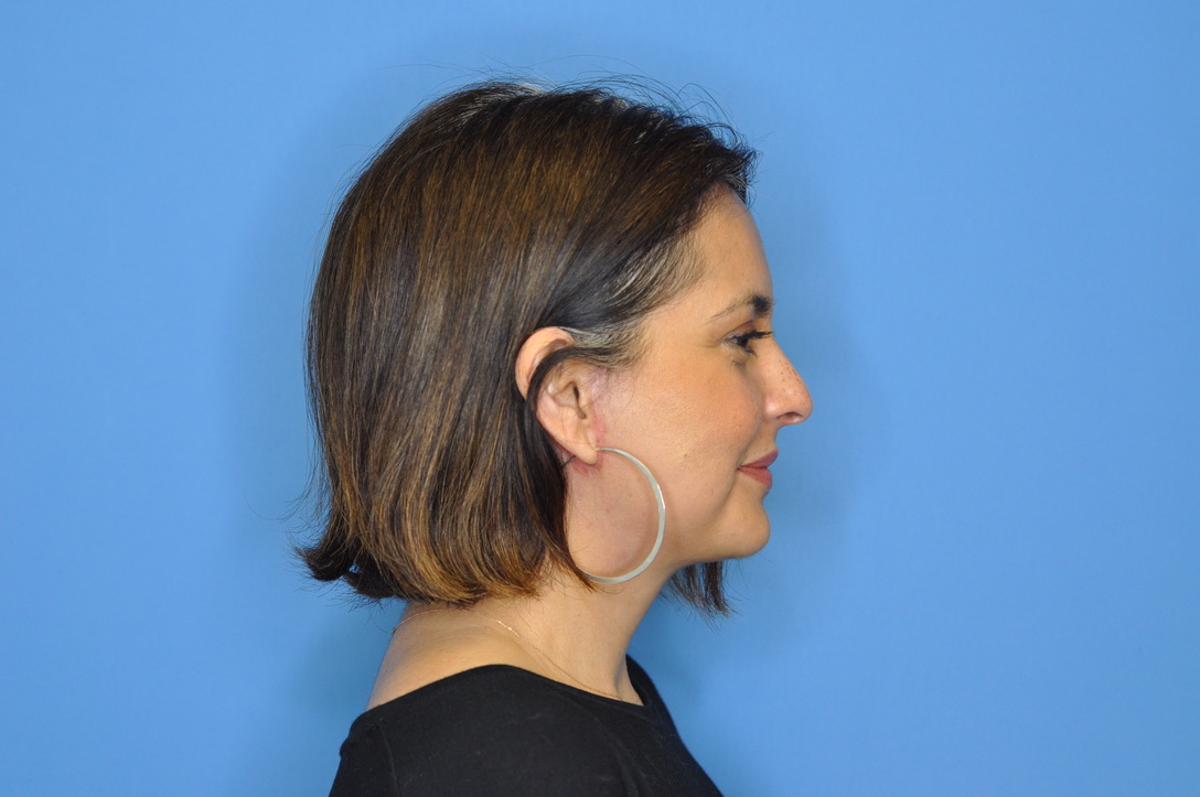 Facelift Before & After Photo Patient 01 Thumbnail