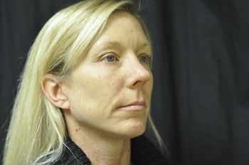 Facelift Before & After Patient 04