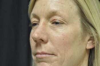 Facelift Before & After Photo Patient 04 Thumbnail