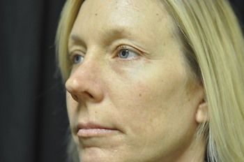 Facelift Before & After Photo Patient 04 Thumbnail