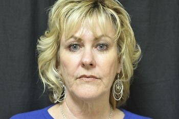 Facelift Before & After Photo Patient 05 Thumbnail