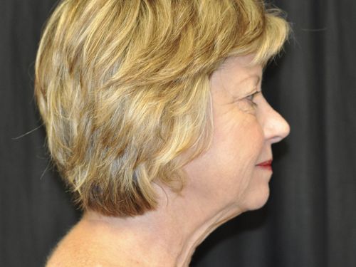 Facelift Before & After Patient 06