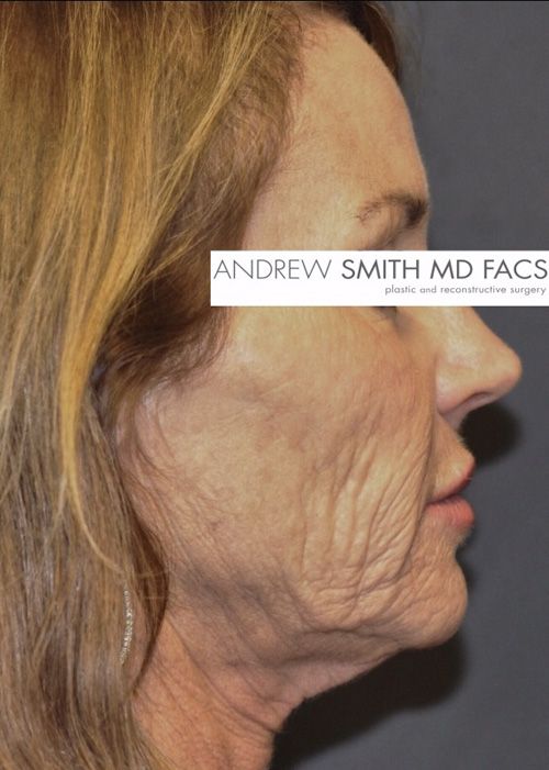 Facelift Before & After Patient 07