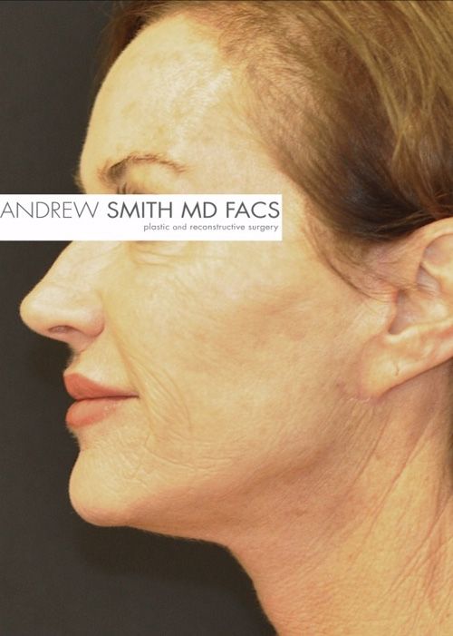 Facelift Before & After Patient 07