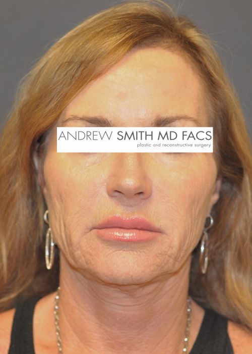 Facelift Before & After Photo Patient 07 Thumbnail