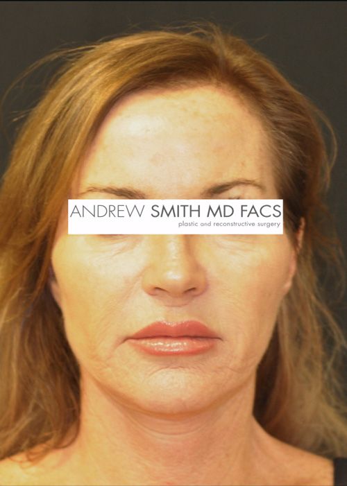 Facelift Before & After Photo Patient 07 Thumbnail
