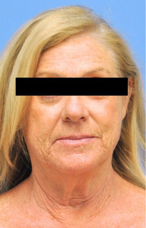 Facelift Before & After Patient 08