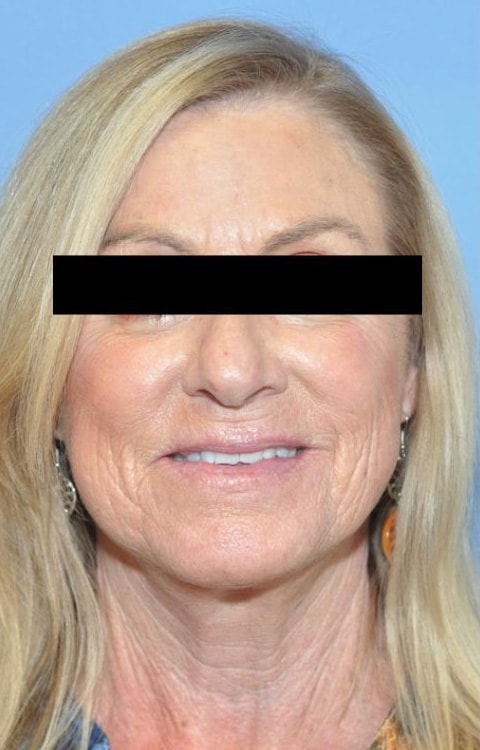 Facelift Before & After Patient 08