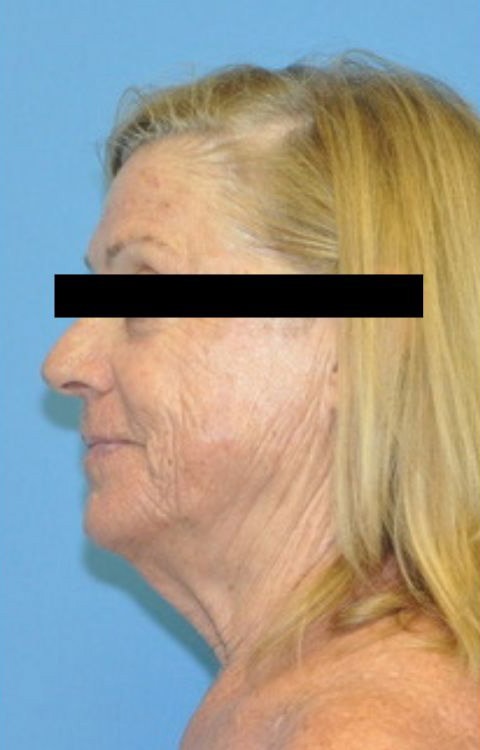 Facelift Before & After Patient 08