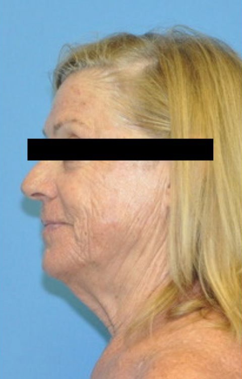 Facelift Before & After Photo Patient 08 Thumbnail