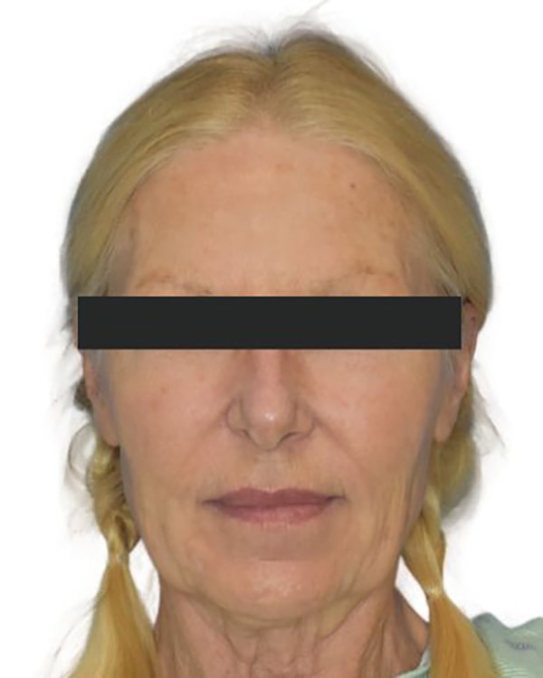 Facelift Before & After Photo Patient 09 Thumbnail