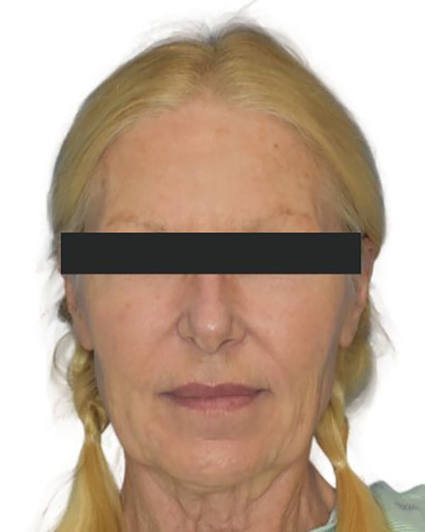 Facelift Before & After Patient 09