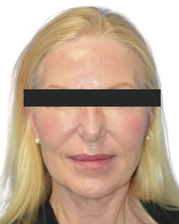 Facelift Before & After Patient 09